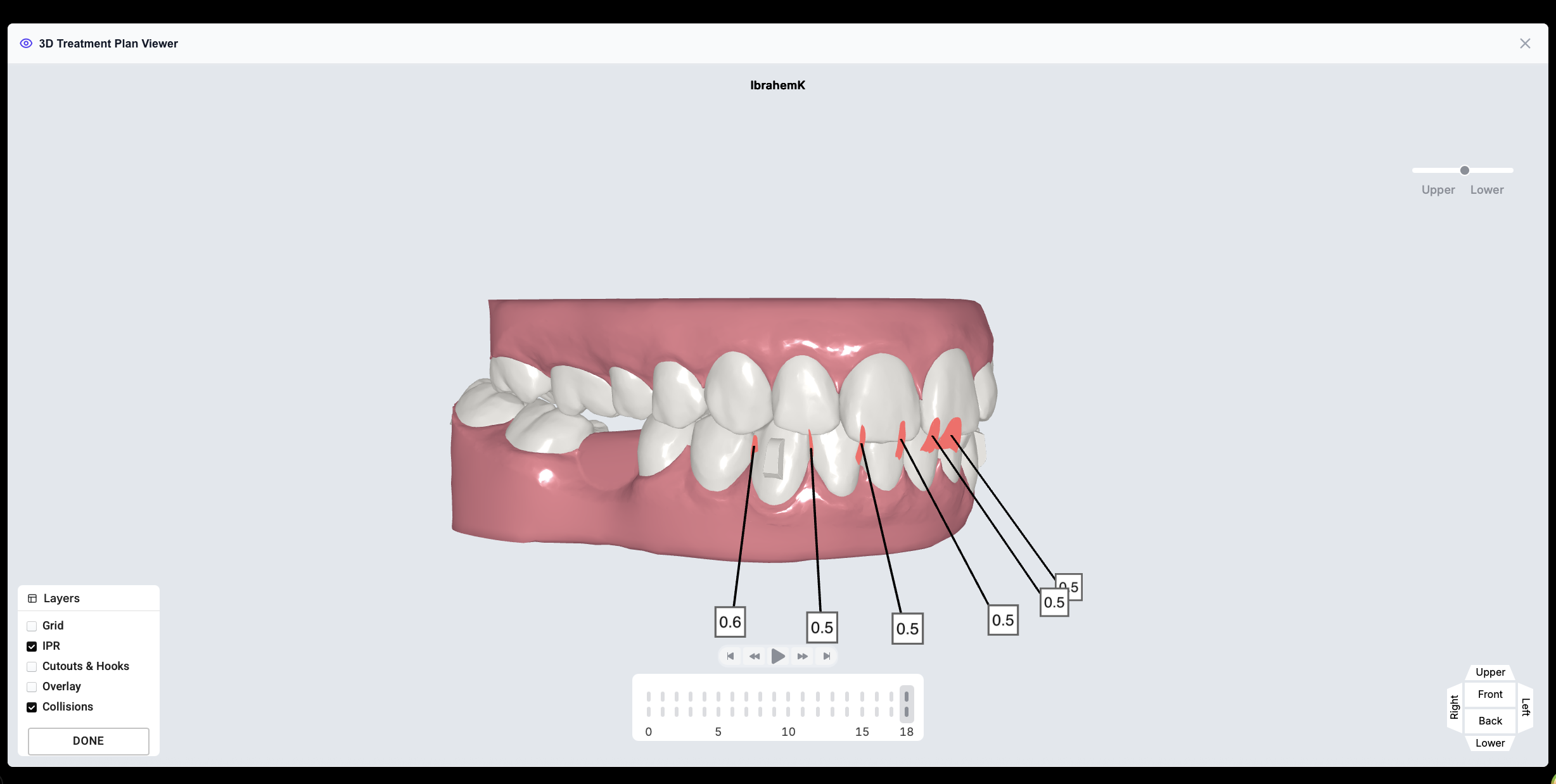 Revolution Aligners 3D treatment plan viewer with IPR overlays.